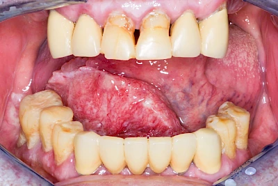 Beispiele: Einschmelzung & Geschwür