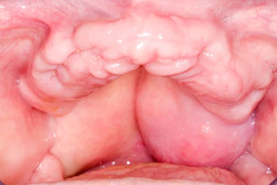 Beispiele: Einschmelzung & Geschwür