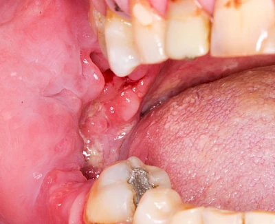 Beispiele: Einschmelzung & Geschwür