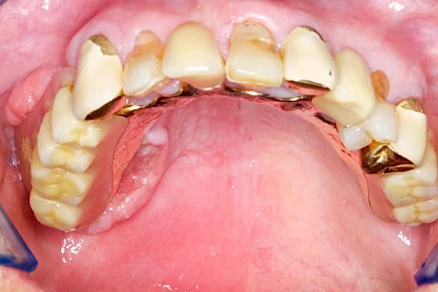 Beispiele: Einschmelzung & Geschwür