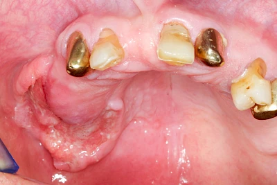 Beispiele: Einschmelzung & Geschwür