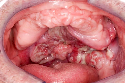 Beispiele: Einschmelzung & Geschwür