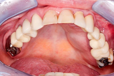 Beispiele: Einschmelzung & Geschwür