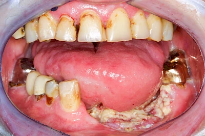 Beispiele: Einschmelzung & Geschwür