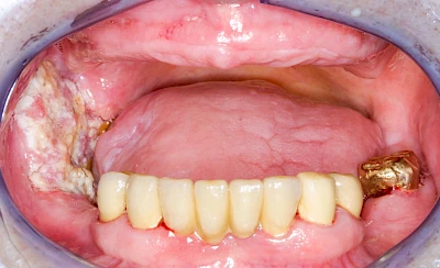 Beispiele: Einschmelzung & Geschwür