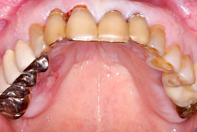 Beispiele: Einschmelzung & Geschwür