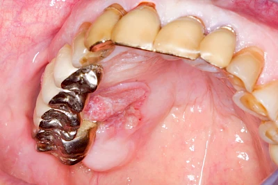 Beispiele: Einschmelzung & Geschwür