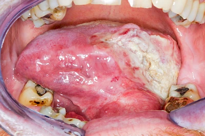 Beispiele: Einschmelzung & Geschwür