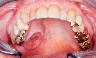 Beispiele: Einschmelzung & Geschwür