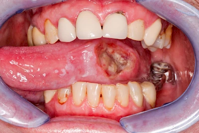 Beispiele: Einschmelzung & Geschwür