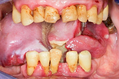 Beispiele: Einschmelzung & Geschwür