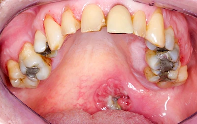 Beispiele: Einschmelzung & Geschwür