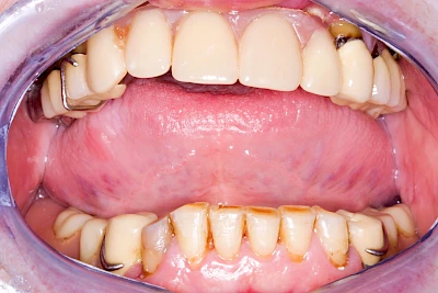 Beispiele: Einschmelzung & Geschwür