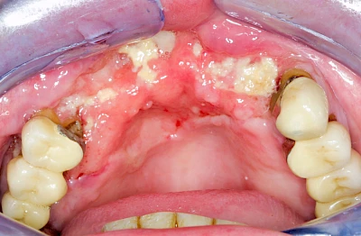 Beispiele: Einschmelzung & Geschwür
