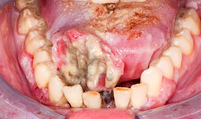 Beispiele: Einschmelzung & Geschwür