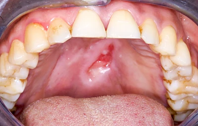 Beispiele: Einschmelzung & Geschwür