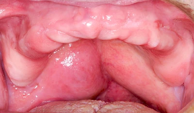 Beispiele: Einschmelzung & Geschwür