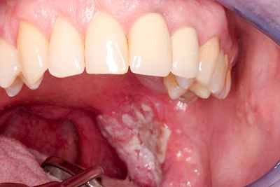 Beispiele: Einschmelzung & Geschwür