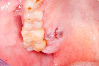 Beispiele: Einschmelzung & Geschwür