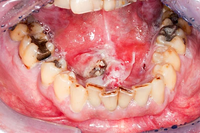 Beispiele: Einschmelzung & Geschwür