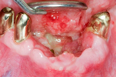 Beispiele: Einschmelzung & Geschwür
