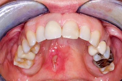 Beispiele: Einschmelzung & Geschwür