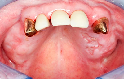 Beispiele: Einschmelzung & Geschwür