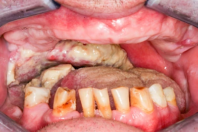 Beispiele: Einschmelzung & Geschwür