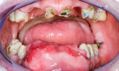 Beispiele: Einschmelzung & Geschwür