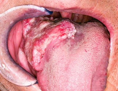 Beispiele: Einschmelzung & Geschwür