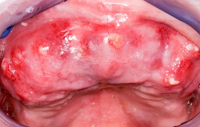 Beispiele: Einschmelzung & Geschwür