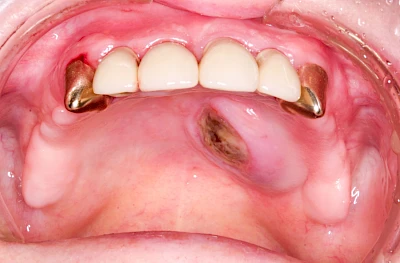 Beispiele: Einschmelzung & Geschwür