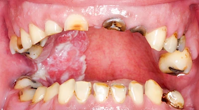 Beispiele: Einschmelzung & Geschwür