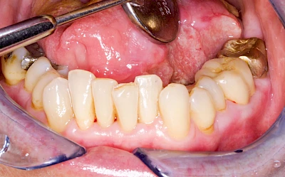 Beispiele: Einschmelzung & Geschwür