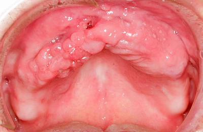 Beispiele: Einschmelzung & Geschwür