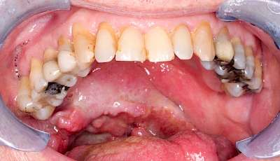 Beispiele: Einschmelzung & Geschwür