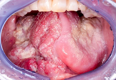 Beispiele: Einschmelzung & Geschwür