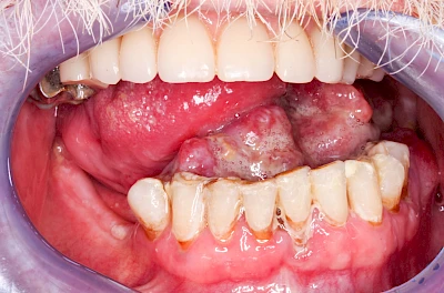 Beispiele: Einschmelzung & Geschwür