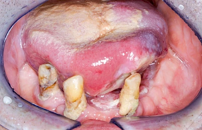 Beispiele: Einschmelzung & Geschwür