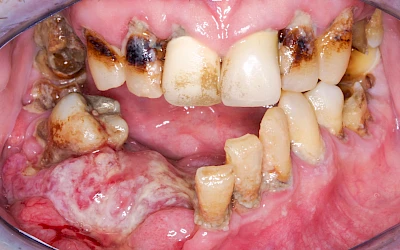 Beispiele: Einschmelzung & Geschwür