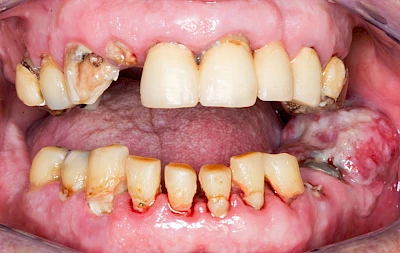 Beispiele: Einschmelzung & Geschwür