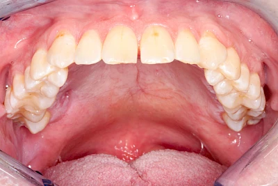 Beispiele: Einschmelzung & Geschwür