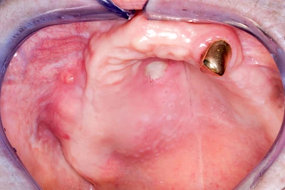 Beispiele: Einschmelzung & Geschwür