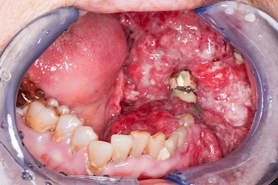 Beispiele: Einschmelzung & Geschwür