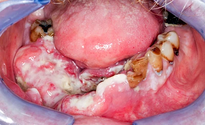 Beispiele: Einschmelzung & Geschwür