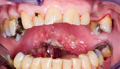 Beispiele: Einschmelzung & Geschwür