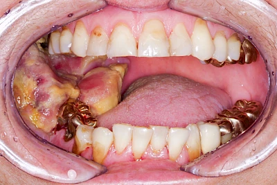 Beispiele: Einschmelzung & Geschwür