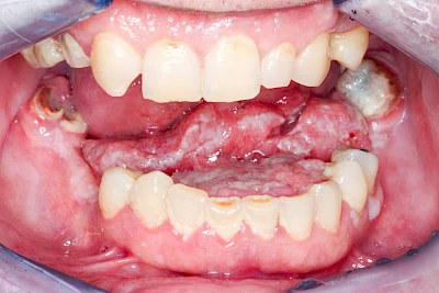 Beispiele: Einschmelzung & Geschwür