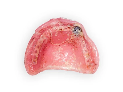 Beispiele: Schwellung ohne Eiter (faltenförmig)