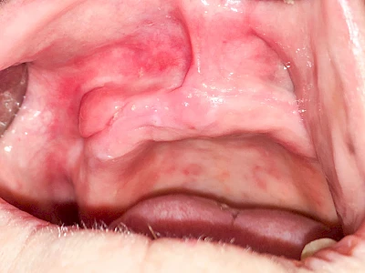 Beispiele: Schwellung ohne Eiter (faltenförmig)